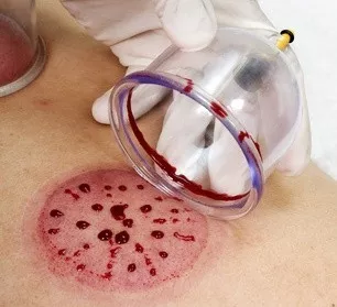 Terapi Bekam: Tips Sehat dan Aman untuk Tubuh